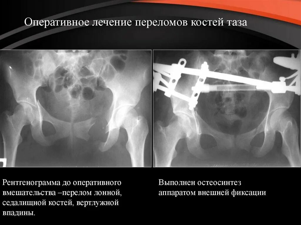 Оперативное лечение перелома костей. Перелом костей таза рентгенограмма. Перелом таза аппарат наружной фиксации. Перелом таза остеосинтез. Остеосинтез костей таза.