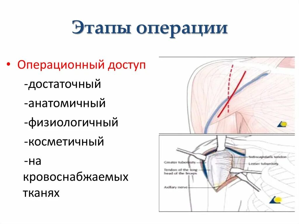 Операции по этапности. Основной этап операции. Назовите этапы операции