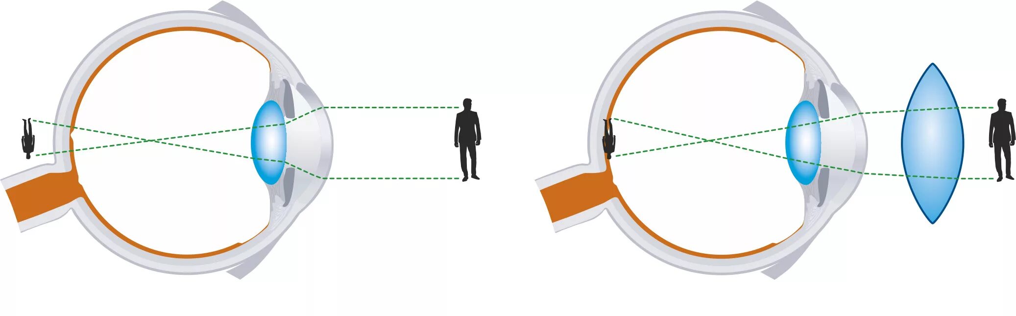 Фокусировка лучей света на внутренней. Линзы для глаз для зрения дальнозоркость. При гиперметропии изображение фокусируется. Миопия гиперметропия астигматизм. Близорукость дальнозоркость астигматизм.