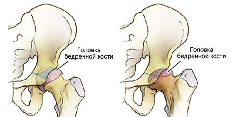 Отек шейки бедра. Вертлужная впадина тазобедренного сустава. Асептический некроз бедренных костей. Асептический некроз шейки бедренной кости. Асептический тазобедренного сустава.