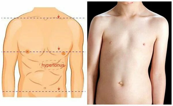 Деформация грудной клетки воронкообразное врожденное 1 степени. Воронкообразная грудная клетка у младенца. Воронкообразная грудная клетка у ребенка. Ребенок 1 2 грудная клетка. Воронкообразная и килевидная грудная клетка.