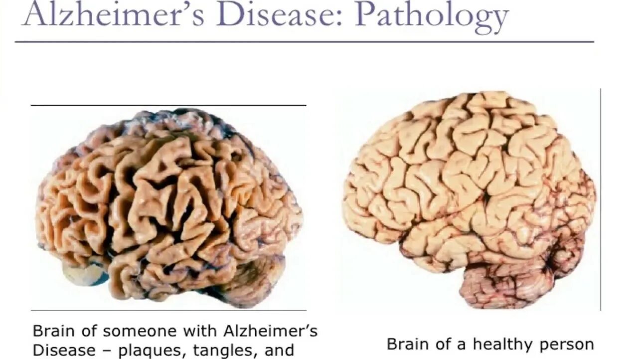 Болезнь Альцгеймера мозг. Мозг человека при болезни Альцгеймера. Головной мозг при болезни Альцгеймера. Brain disease
