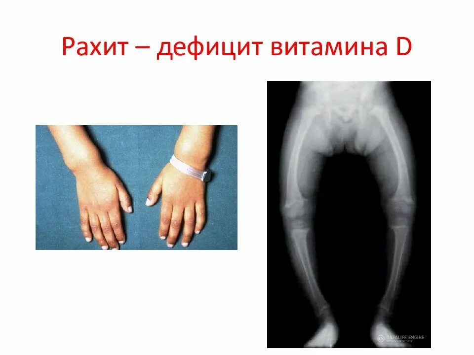 Рахит нехватка какого витамина. Хондродистрофия, рахит. рахит дефицит витамина д. фосфоропенический рахит. недостаток витамина д.