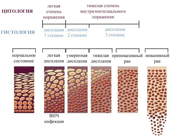 Дисплащиятшейки матки. Дисплазия шейки матки фотодинамическая терапия. Дисплазия тяжелой степени шейки матки. Дисплазия шейки 1 степени причины. Дисплазия шейки матки диагноз формулировка.