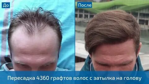 Пересадка в турции