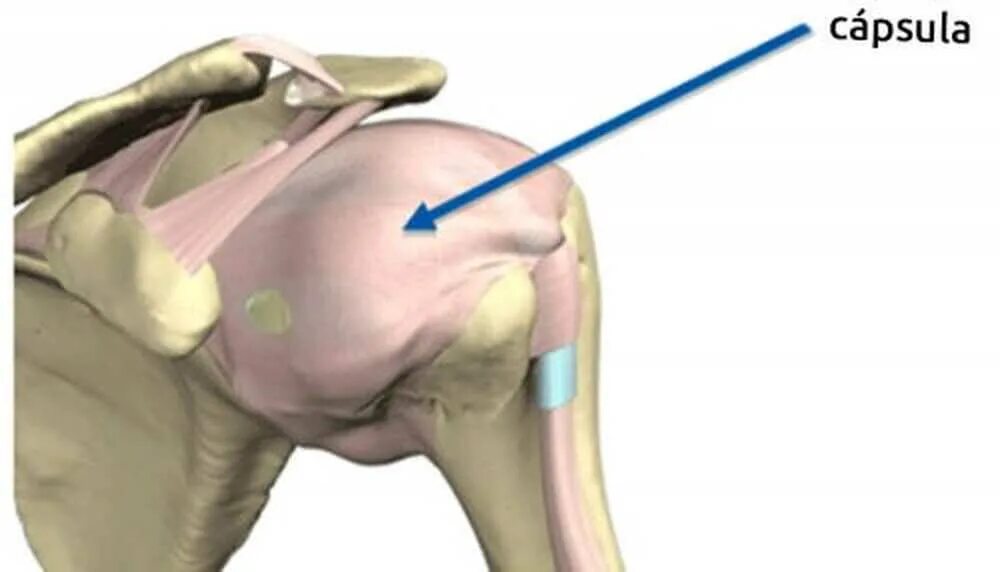 Как лечить капсулит. Капсулит плечевого сустава. Фиброзирующий капсулит. Адгезивный капсулит плеча рентген.