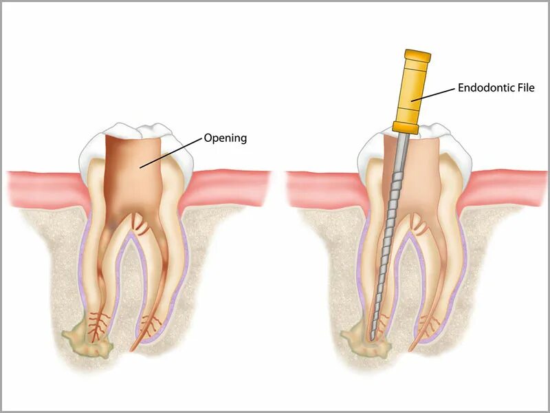 Root canal. 26 Tooth root canal Sysems.