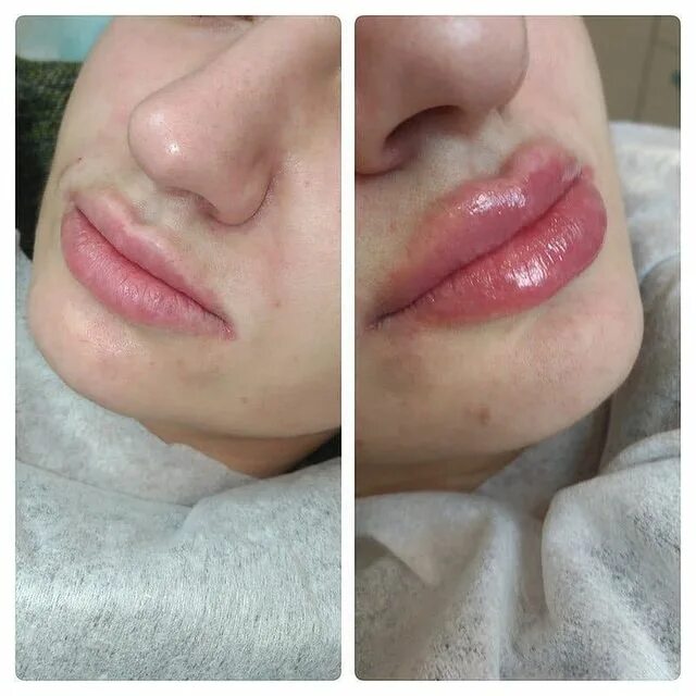 увеличение губ до и после. 5 филлера в губах. увеличение губ гиалуроновой кислотой 5мл. увеличение губ 0. 5 мл зажившие.