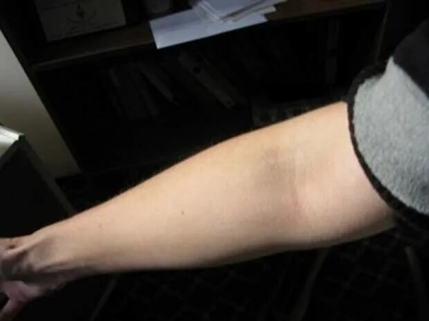 Как выглядит рука после укола Bruising 101: Why some people bruise easily, how bruises should look during heal