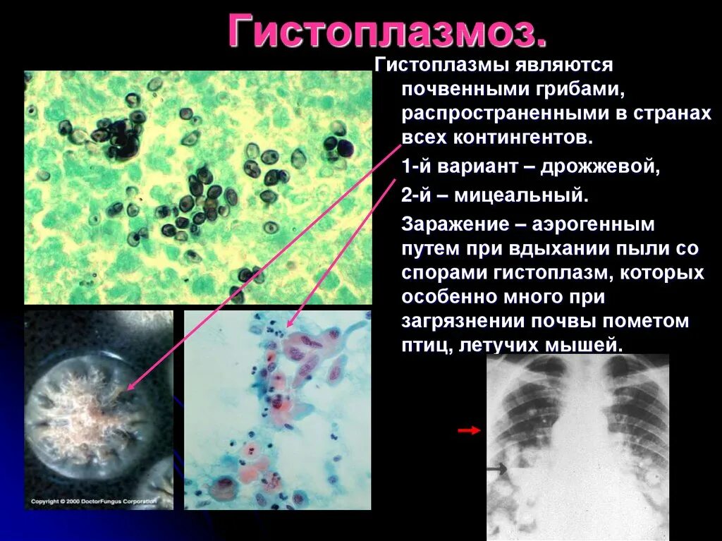 Гистоплазмоз это. Гистоплазмоз это