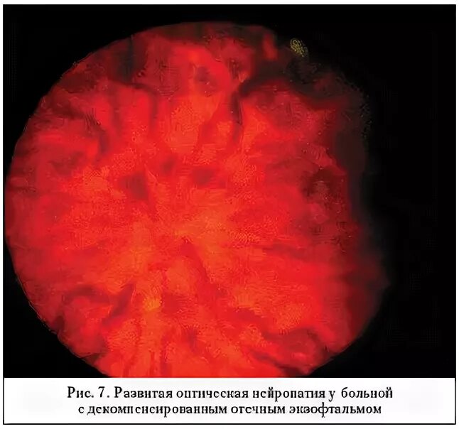 Ишемическая нейропатия сетчатки. Ишемическая нейропатия зрительного нерва. Передняя ишемическая нейропатия зрительного нерва. Задняя ишемическая нейрооптикопатия. Нейропатия глаза