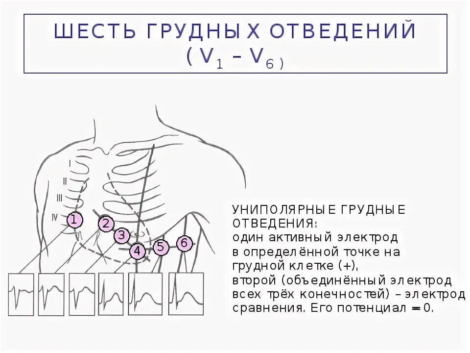 Расположение электродов при экг на грудной клетке Картинки ПРОВЕДЕНИЕ ЭКГ АЛГОРИТМ