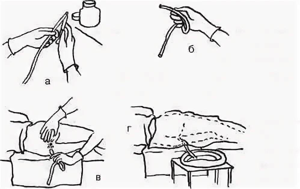 Алгоритм постановки очистительной клизмы сестринское. Постановка газоотводной трубки. Газоотводная трубка алгоритм. Клизма газоотводная трубка показания. Газоотводная трубка манипуляция.