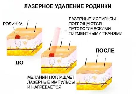 Сколько будет стоить удалить