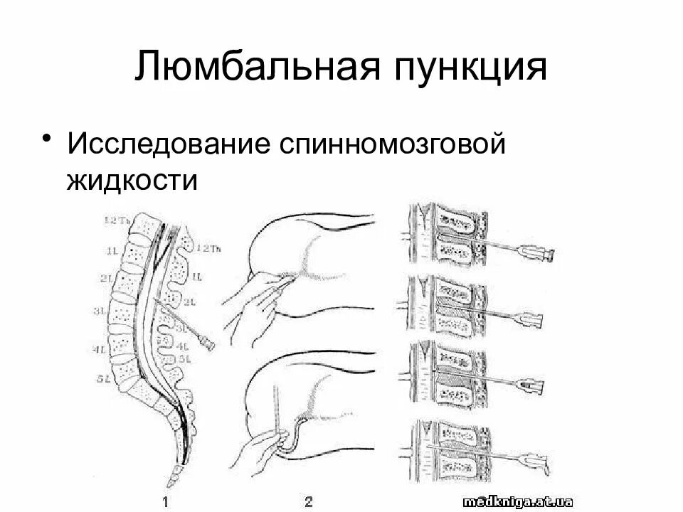 Люмбальная пункция алгоритм. Техника проведения люмбальной пункции. Техника проведения спинномозговой пункции. Точка проведения люмбальной пункции. Люмбальная инъекция техника проведения.