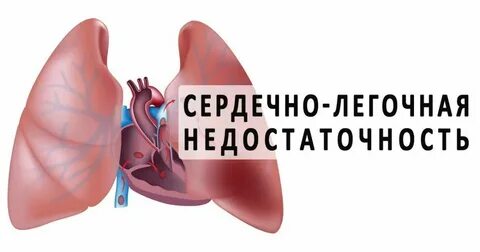 Сердечно легочная недостаточность