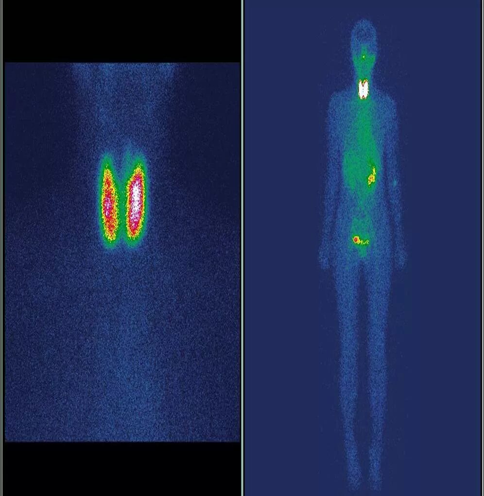 Исследование изотопами. Сцинтиграфия щитовидной железы с 99mтс. Сцинтиграфия щитовидной железы (Технетрил 99 MTC). Диагностическая сцинтиграфия с i-131 радиойоддиагностика. Сцинтиграфия щитовидной железы алгоритм.