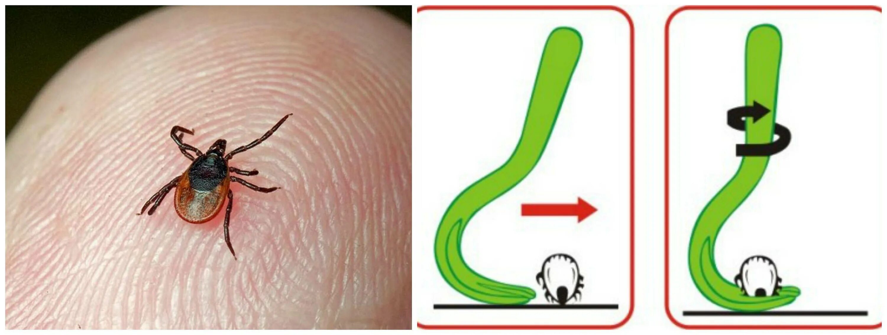 После снятия клеща. Как извлечь клеща на теле. Как удалить клеща у человека в домашних условиях. Как удалить клеща с тела человека.