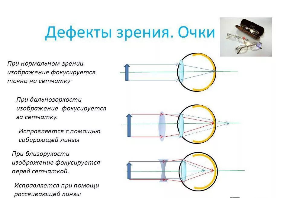 Линзы для зрения дальнозоркость. Дефект зрения близорукость и дальнозоркости физика линзы.. Способы коррекции дефектов зрения. Аномалии рефракции глаза близорукость дальнозоркость таблица. Дефекты зрения дальнозоркость и близорукость и их коррекция.