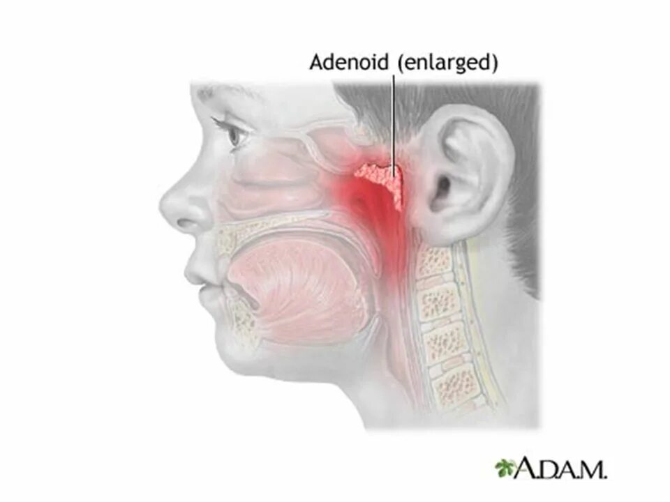 Прогревание носа физиотерапия. Капли от аденоидов для детей. Греют ли нос при аденоидах. Лекарство от аденоидов в нос. Аденоиды у детей 2 стадия.