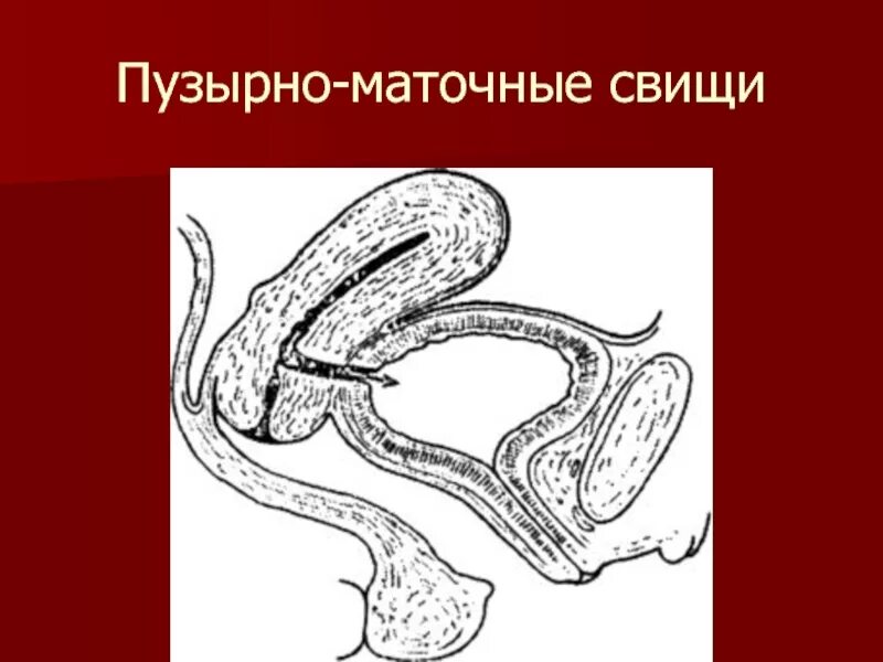 Кишечный свищ. Пузырно кишечный свищ рентген. пузырно влагалищный свищ. пузырно-шеечно-маточные свищи.