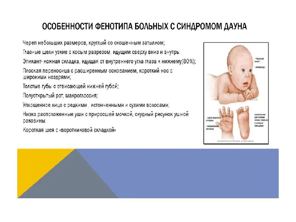 Фенотип ребенка с синдромом дауна