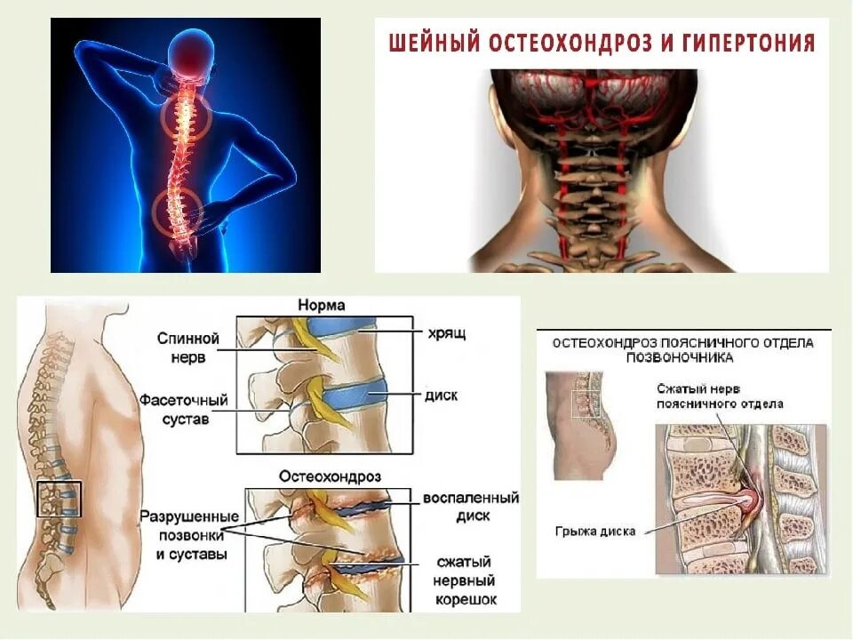 Боли при остеохондрозе поясничного отдела позвоночника. Остеохондроз позвоночника 1 степени симптомы. Остеохондроз грудного отдела позвоночника. Остеохондроз шейного и поясничного отдела позвоночника. Грудной и поясничный остеохондроз.