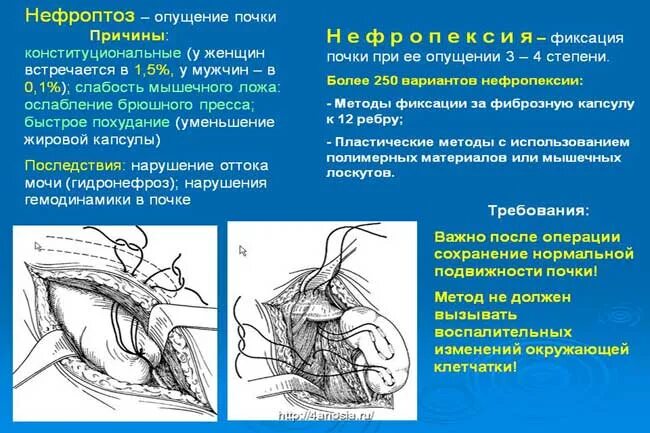 Нефроптоз мкб. Нефроптоз мкб