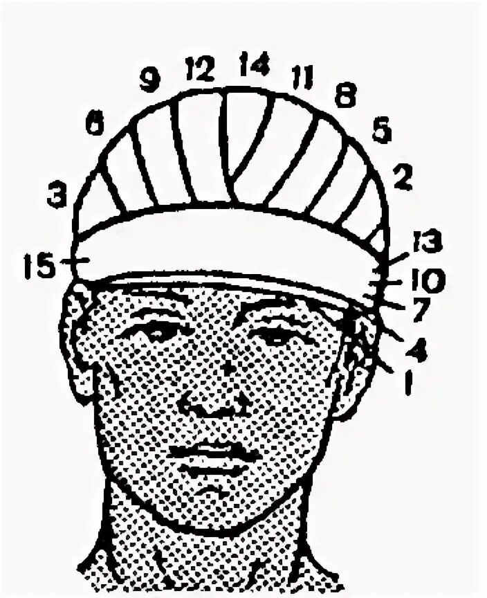 Техника наложения шапочки гиппократа. Перевязка шапочка Гиппократа. Наложение повязки шапка Гиппократа. Шапочка Гиппократа повязка алгоритм. Повязка шапка Гиппократа техника.