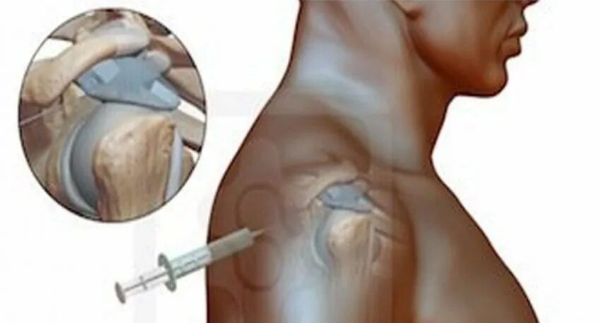 Пункции суставов плечевой сустав. Внутрисуставное Введение в плечевой сустав. Пункция плечевого сустава техника. Инъекция в плечевой сустав.