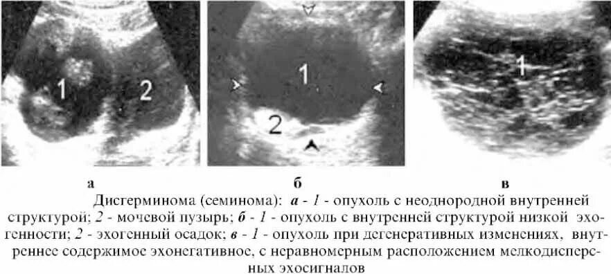 Гранулезоклеточная опухоль яичников УЗИ. Неэпителиальные опухоли яичника. Гранулезоклеточная опухоль яичника на УЗИ. Опухоль яичника макропрепарат. Серозная пограничная опухоль