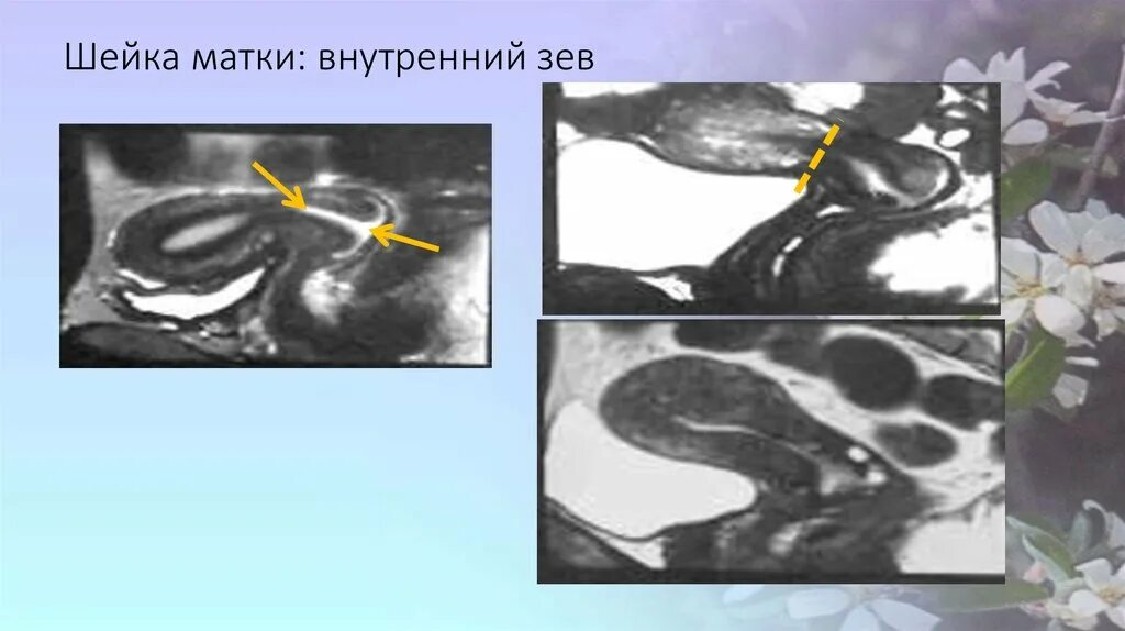 Маточный зев. Шейка матки внутренний зев. Внутренний зев шейки матки сомкнут. Внутренний зев цервикального канала открывается. Расширение маточного зева.