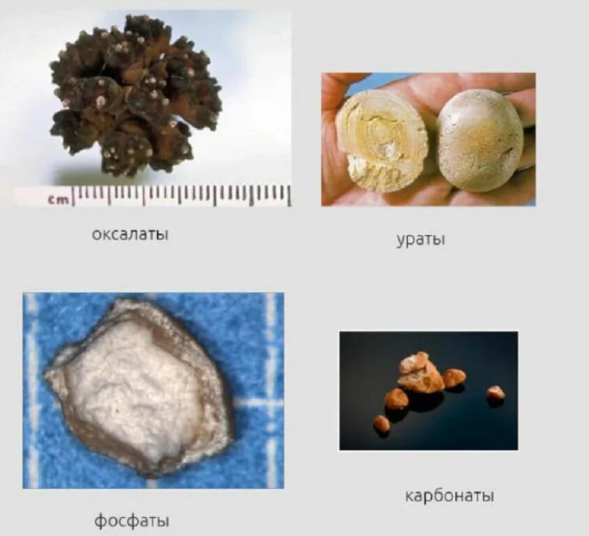 Уратные камни при мочекаменной болезни. Виды конкрементов камней в почках. Ураты фосфаты оксалаты мочекаменная болезнь.
