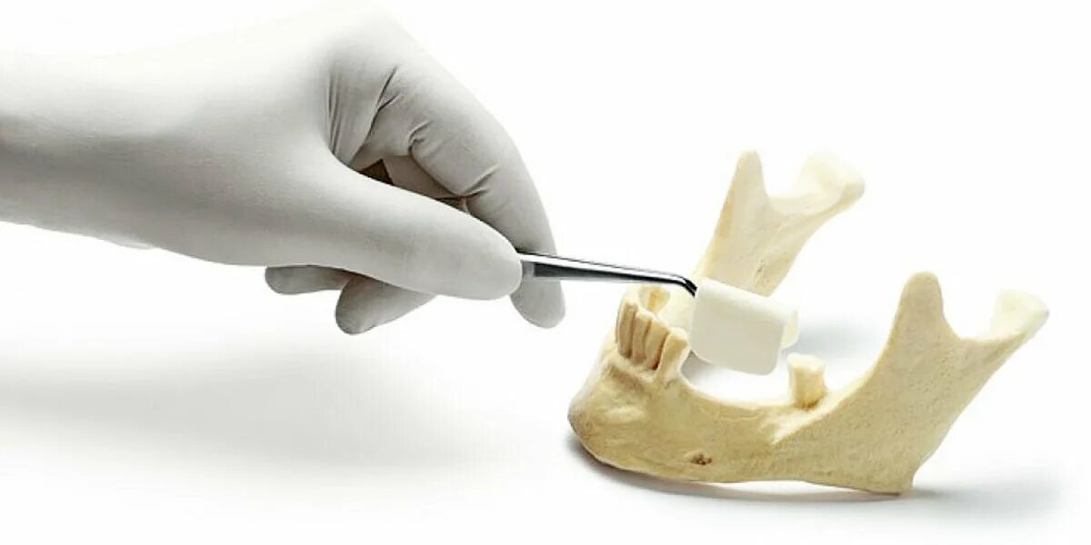 Трансплантант. Костная аугментация челюсти. Костная пластика (остеопластика). Костная пластика аугментация. Костная пластика альвеолярного отростка.