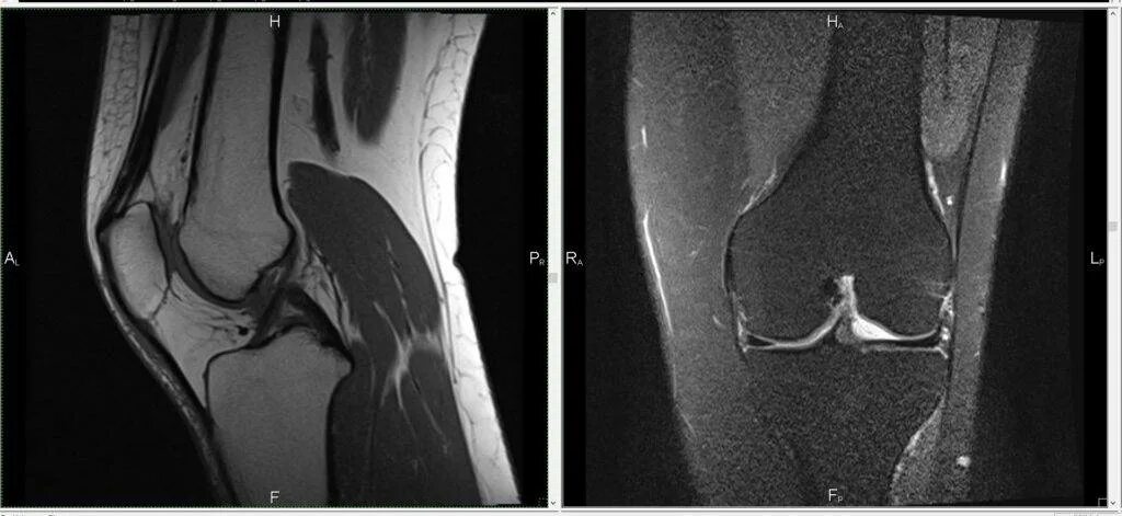 Мрт мениска коленного сустава. Синовиома коленного сустава мрт. Патология надколенника мрт. Мрт исследование коленного сустава.
