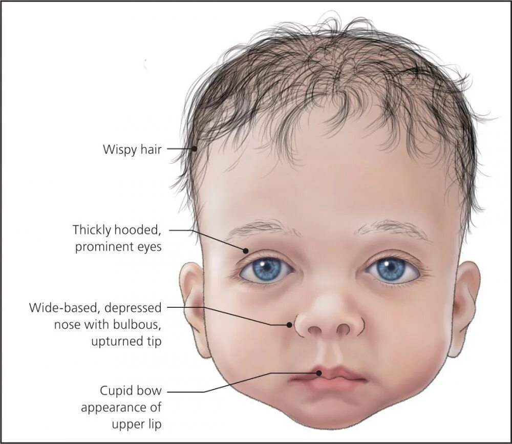 Фенотип ребенка с синдромом дауна. Синдром Нунан симптомы. Клинические проявления синдрома Нунан.