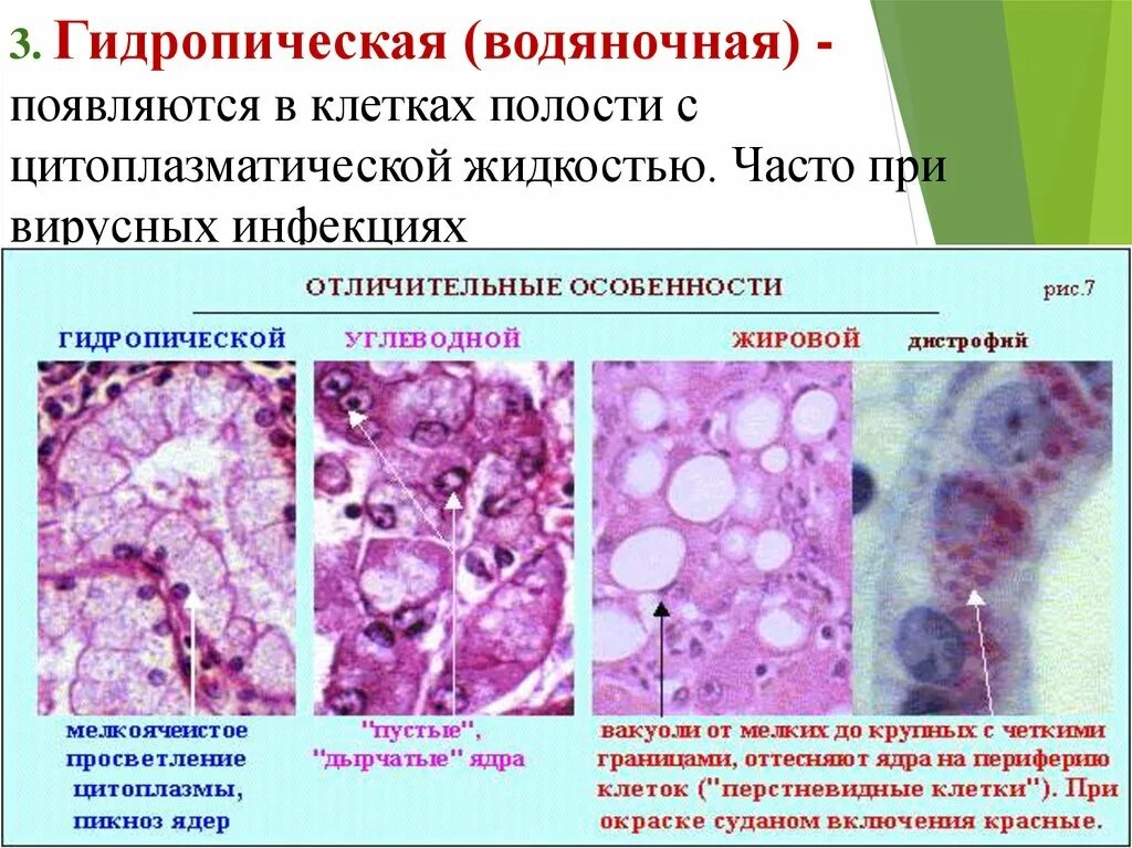 Синдром тельца. Паренхиматозные белковые дистрофии гидропическая. Паренхиматозные углеводные дистрофия почек. Паренхиматозная белковая дистрофия почки. Паренхиматозная белковая зернистая дистрофия.