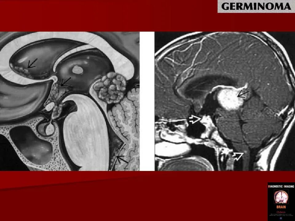 Герминома. Герминома головного мозга.