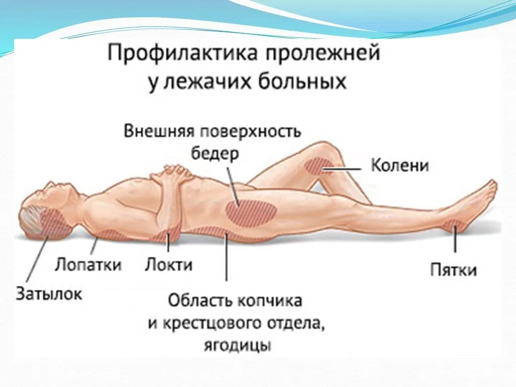 Заболели ягодицы. Пролежни у тяжелобольных пациентов профилактика пролежней. Профилактика пролежней тяжелобольного пациента. Пролежни места образования пролежней у лежачих больных. Профилактика пролежней у лежачих больных памятка.