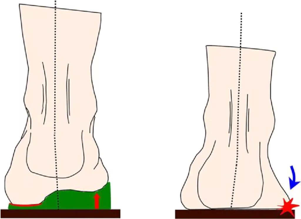 Ортопедическая обувь для детей вальгусная стопа. Ортопедические стельки вальгусная деформация стопы. Стельки при вальгусной деформации стопы у детей. Обувь при вальгусной деформации у взрослых. Вальгусная деформация стопы у взрослых стельки.
