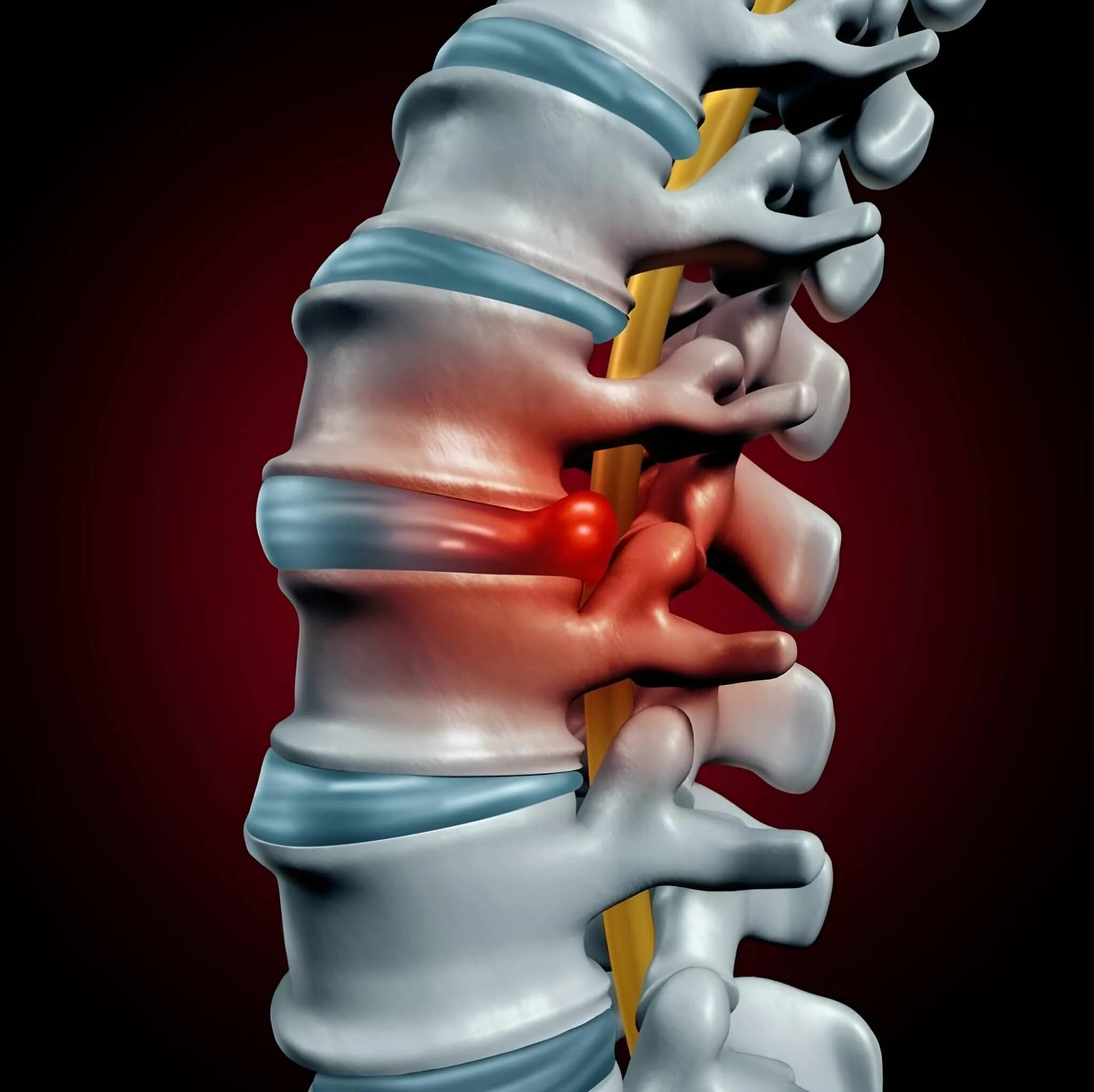 Спинные диски. Грыжа межпозвоночного диска. Позвоночная грыжа поясничного отдела. Междисковая грыжа позвоночника. Грыжи межпозвоночных дисков поясничного отдела.