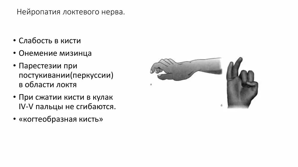 Симптомы поражения локтевого нерва неврология. Нейропатия локтевого нерва диагноз. Нейропатия локтевого и лучевого нерва. Нейропатиия блоковогонерва.