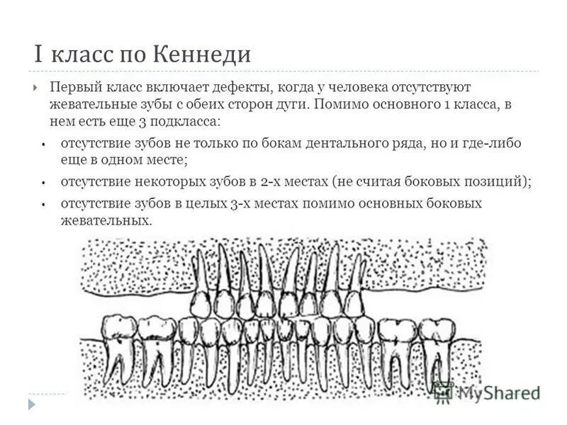 Концевые дефекты зубных рядов. Концевые дефекты зубных рядов