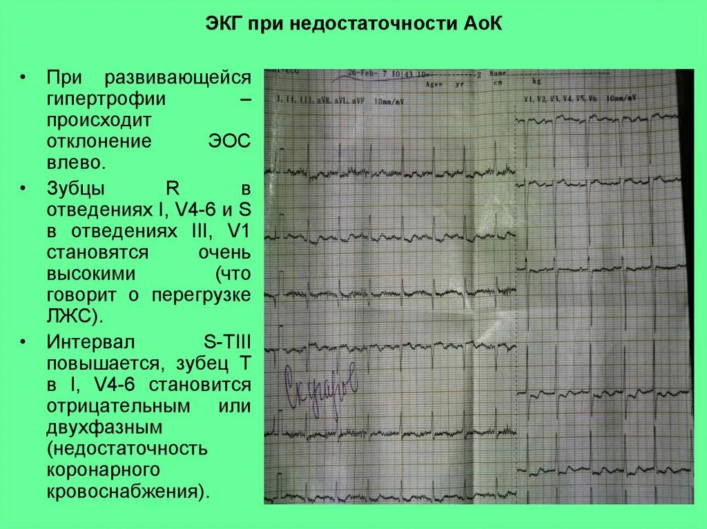 Отклонение ЭОС влево на ЭКГ. Отклонение оси вправо на ЭКГ. Отклонение ЭОС влево и вправо на ЭКГ. ЭКГ электрическая ось отклонена. Сердце отклонено вправо