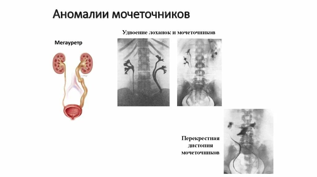 Аномалии мочевыводящих путей. Аномалии развития почек и мочеточников. неполное удвоение лоханки почки. аномалии развития лоханок почек. аномалия развития почек удвоение.