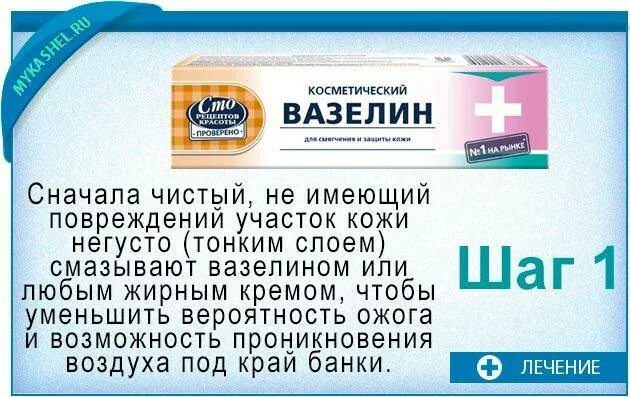 Банки при болях в спине. Как правильно ставить банки на спину при кашле взрослому. Сколько дней ставить медицинские банки.