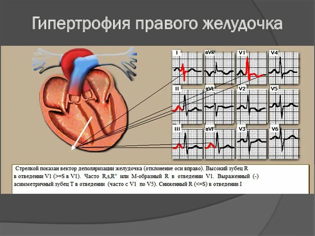 Гипертрофия левого желудочка на ЭКГ. Желудочковая гипертрофия ЭКГ. Гипертрофия желудочка сердца на ЭКГ. ЭКГ синдром гипертрофии желудочков.