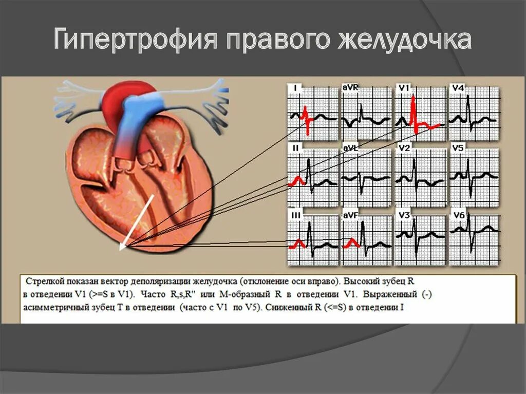 Гипертрофия левого предсердия левого желудочка. Гипертрофия левого желудочка на ЭКГ. Гипертрофия желудочков на ЭКГ. Желудочковая гипертрофия ЭКГ. ЭКГ правый гипертрофия правый желудочек.