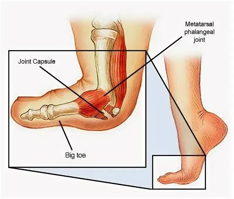 Середина стопы. Травмы стопы при ходьбе. Жидкость в связках стопы. Растянуты связки большого пальца ног. Растяжение пальца стопы.