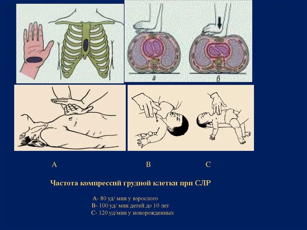 Частота компрессий грудной клетки. Компрессия грудной клетки при сердечно легочной реанимации. Место компрессии грудной клетки при СЛР взрослому. Частота компрессий грудной клетки при СЛР. Сжатие груди